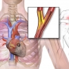 Understanding Heart Disease In Later Life